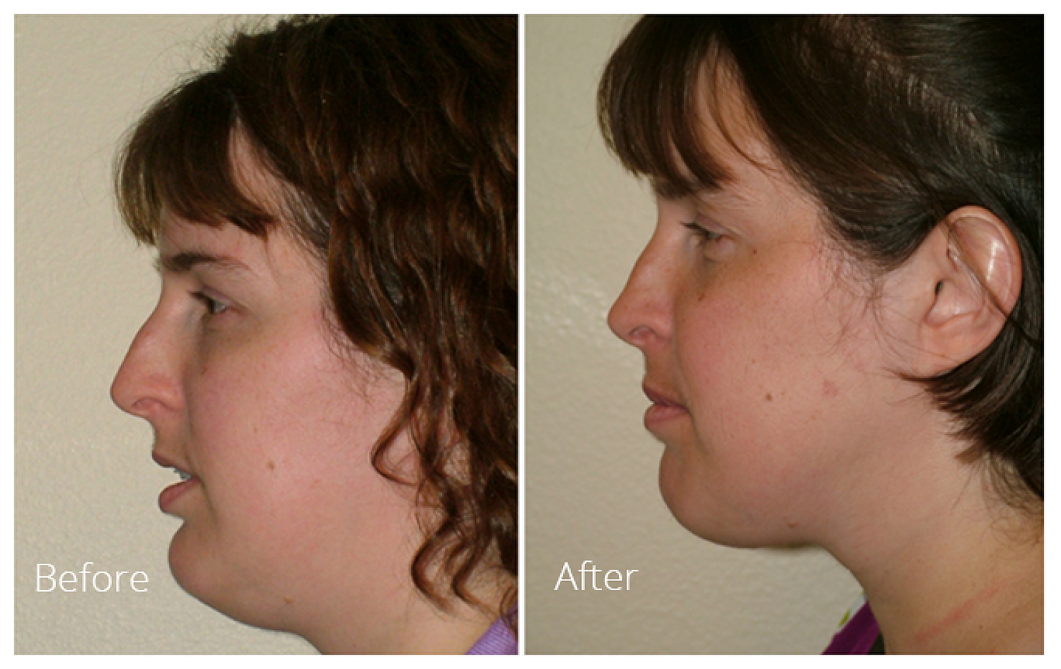 Bimaxillary advancement surgery