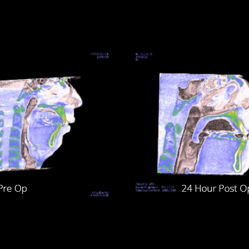 Our Bimaxillary Advancement Abstract Appears in SLEEP Publication