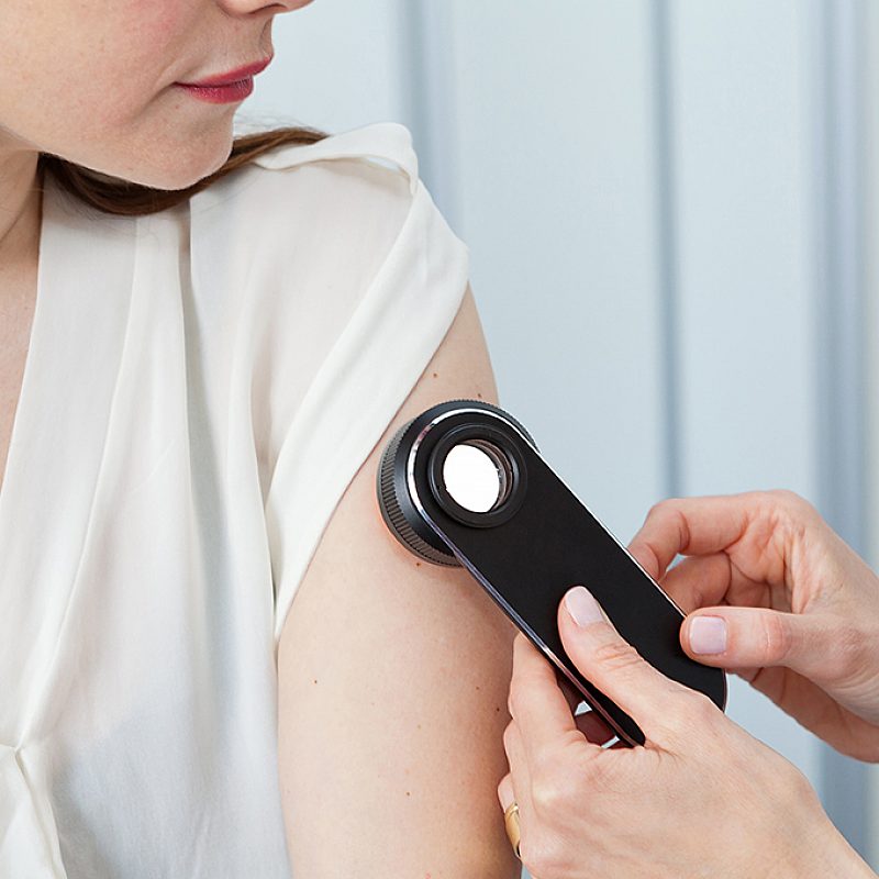 Study: Untreated Sleep Apnea Connected With More Aggressive Melanoma